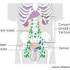 Weakness or swelling in the legs some men experience general weakness and swelling in the legs during advanced prostate cancer. 1