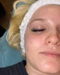 Chemical peel before and after Pt. 2!!, #chemicalpeel #acnetreatment  #dermologica