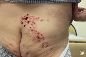 Image result for herpes zoster
