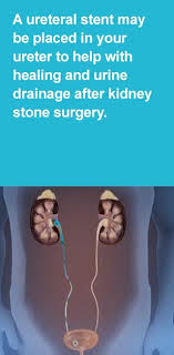 Pin On Kidney Stones