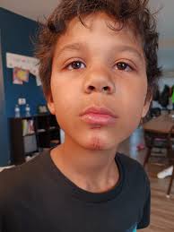 ✨ROWE CASA TESTIMONIAL✨ My child was bit by a dog while visiting with a  friend. The first two pictures show about an hour after it happened. By  that evening it had began