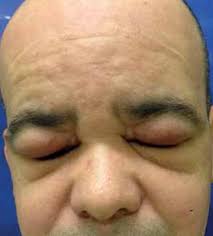 Peeling skin syndrome (acral peeling skin syndrome, continual peeling skin syndrome, familial continual skin peeling, idiopathic deciduous skin, keratolysis exfoliativa congenita) pfeiffer syndrome; Scielo Brasil Morbihan Syndrome A Case Report And Literature Review Morbihan Syndrome A Case Report And Literature Review