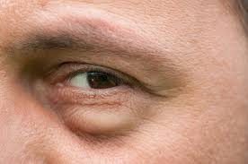 We did not find results for: Gesichtsschwellung Ursachen Behandlung Und Hausmittel Heilpraxis
