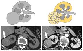 Image result for Helical CT Urogram