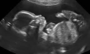 Ultrasound Imaging Baby S First Image 3d 4d Ultrasound Groupon