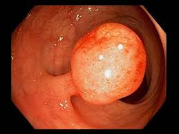Image result for Colonic Polyp