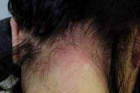 In some cases, the itchiness may be accompanied by flakiness, scaly patches, bumps, and even hair loss. Dry And Itchy Scalp Terra Medical Clinic Singapore