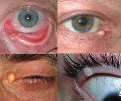 Image result for milium cyst on eyelid