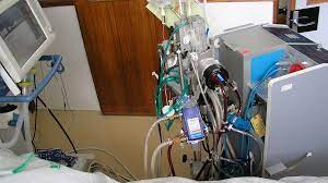 Помимо этого, аппарат применяют для поддержки. Kogo Ne Spaset Ekmo V Rossii Ne Hvataet Apparatov Dlya Borby S Koronavirusnoj Pnevmoniej Daily Storm