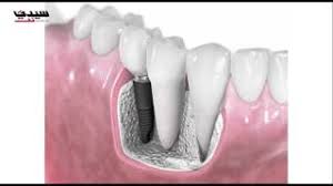 تقنية جديدة لزراعة الأسنان في نصف ساعة Youtube