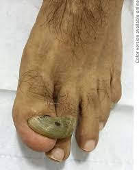 Image result for Onychogryphosis feet
