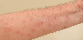 Image result for scabies human bites