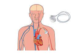 It can also eat away form_title= motion detector lights form_header= feel safe with motion detector lights in your home! Protecting Implantable Medical Devices From Electromagnetic Interference Passive Components Blog