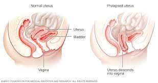Prolapso Uterino Middlesex Health