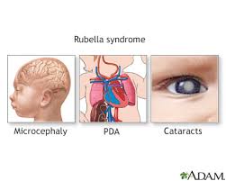 Image result for Rubella