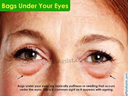 What Causes Bags Under Your Eyes And How To Get Rid Of It Bagsunderyoureyes Undereyesmakeup Puffy Bags Under Eyes Eye Bags Under Eye Bags
