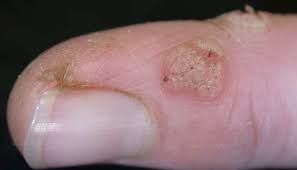 We did not find results for: Periungual Warts Pictures Treatment And Prevention