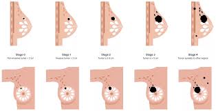 Image result for Breast Cancer Staging