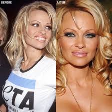 Celebrity plastic surgery before and after photos of julia roberts reveal a youthful and vibrant celebrity who has all it takes to remain successful. Celebrity Plastic Surgery A Brief History Allure
