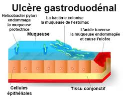 Only a doctor can tell if symptoms are caused by cancer or some other problem. Ulcere Gastro Duodenal Symptomes Traitement Definition Docteurclic Com