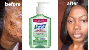 I Used Hand Sanitiser To Clear Acne In 24 Hours Youtube