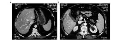 Prostate cancer is a common type of cancer in men, according to the mayo clinic. Partial Response Of Liver Metastases Treated With Abiraterone In Castration Resistant Prostate Cancer A Case Report