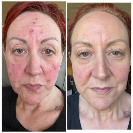 What a difference a week makes with #ptt6 , @calecimprofessional truly  works miracles with the skin and your hair!, Use my code kelleymartell10  for 10% their website!, ...