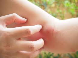 Image result for mosquito bite