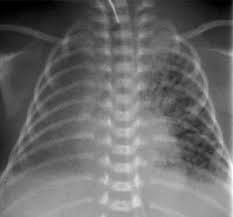 It first appears too complicated to read the chest xrays because we barely know what. Lung Disease In Premature Neonates Radiologic Pathologic Correlation Radiographics