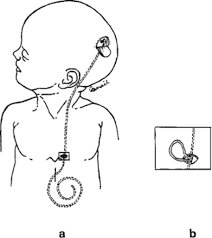 Distal End Revision Of Ventriculoperitoneal Shunts Sparing Minilaparotomy In Journal Of Neurosurgery Volume 85 Issue 6 1996