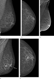 Calcifications usually can't be felt, but they appear on a mammogram. Digital Breast Tomosynthesis Reduces Rate Of Eurekalert
