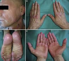 Image result for Connective Tissue Disorder