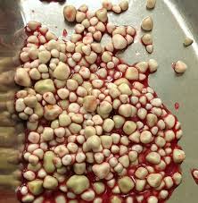 Image result for Gallstone