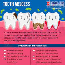 What Is Tooth Abscess Pharmacy Tooth Infection Harlem New York