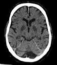 Sauerstoffmangel (Gesundheit) - Definition, Bedeutung - Online