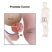 If you are diagnosed with prostate cancer, it is not your fault. Prostate Cancer Wikipedia