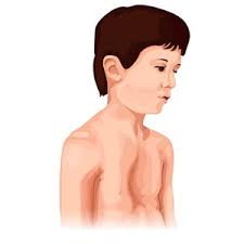 Image result for Pectus Excavatum