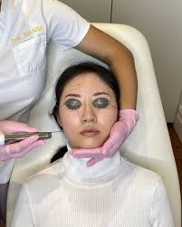 Laser For Spider Veins Archives