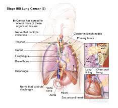 Department Of Surgery Non Small Cell Lung Cancer