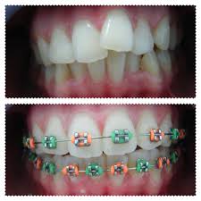 Black And White Braces Color Pin By Drg H Nanang Firmansyah On Braces Cute Braces Colors Braces Colors Braces Colors Combinations