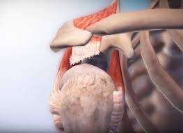 Image result for Rotator Cuff Rupture