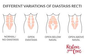 It is essentially a cosmetic condition, with no. Self Testing Diastasis Recti 4 Simple Ways To Test Yourself Ryc