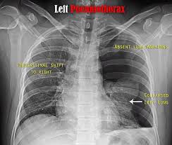 Cannot be detected even by the roentgen rays. Pneumothorax Gaz Wiki