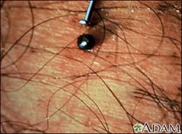 Image result for infected tick bite