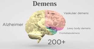 Alzheimers sygdom viser sig ved hukommelsesbesvær og problemer med at finde ord. Forskning Og Viden Om Demens Alzheimer