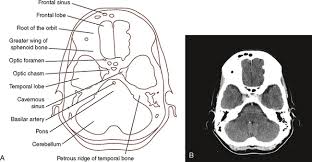 Cross section of a human bone showing bone marrow, spongy bone and blood vessels. Sectional Anatomy For Radiographers Radiology Key
