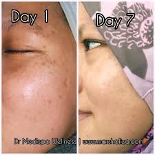 Demikian beberapa cara menghilangkan jerawat dalam 1 hari. Selepas 7 Hari Rawatan Dermapen Microneedle Di Dr Medispa Wellness Berjaya Pudarkan Parut Jerawat Marshalizadotcom