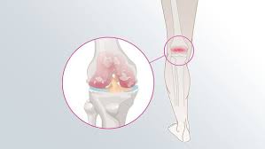 Lorsque les os se touchent, des raideurs ou des blocages apparaissent. Arthrose Definition Ursachen Und Therapie Medi