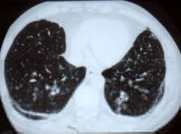 1,053 likes · 17 talking about this. Asbestose Actualites Medicales Quotidienne Actualite Sante
