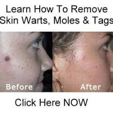 The burns will affect the skin, not the hair follicle, due to the excess of laser energy applied during the treatment. Mole And Laser Hair Removal Dangers High Risk Learn Why Inside Laser Hair Removal Wart Treatment How To Remove